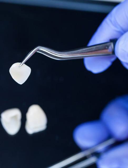 Dentist carefully picking up a dental veneer